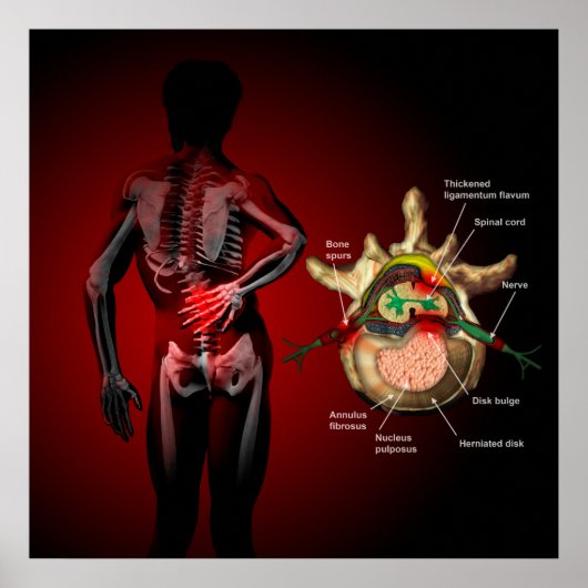Back pain poster (Voorkant)