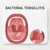 Bacteriële tonsillitis muismat (Voorkant)