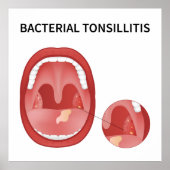 Bacteriële tonsillitis poster (Voorkant)