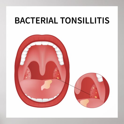 Bacteriële tonsillitis poster (Voorkant)