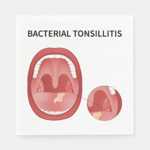 Bacteriële tonsillitis servet