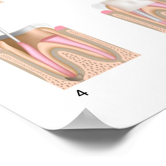 Behandeling van wortelkanaaltjes Poster ongeacht d (Hoek)