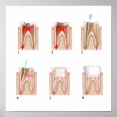 Behandeling van wortelkanaaltjes Poster ongeacht d (Voorkant)