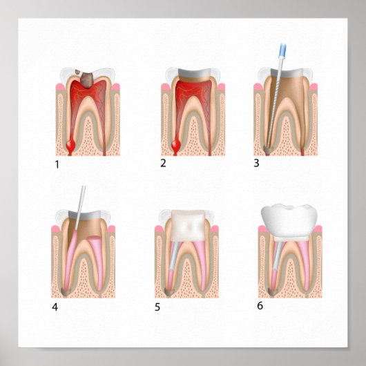 Behandeling van wortelkanaaltjes Poster ongeacht d (Voorkant)