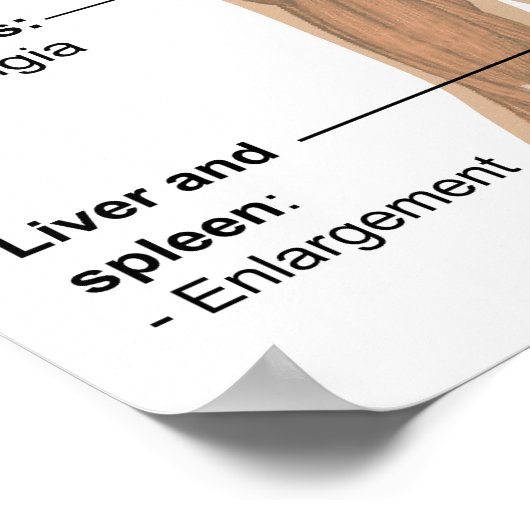 Belangrijkste symptomen van acute HIV-infectie Poster (Hoek)