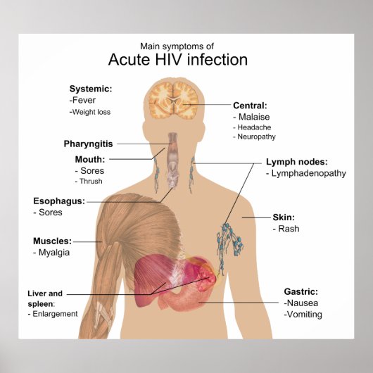 Belangrijkste symptomen van acute HIV-infectie Poster (Voorkant)