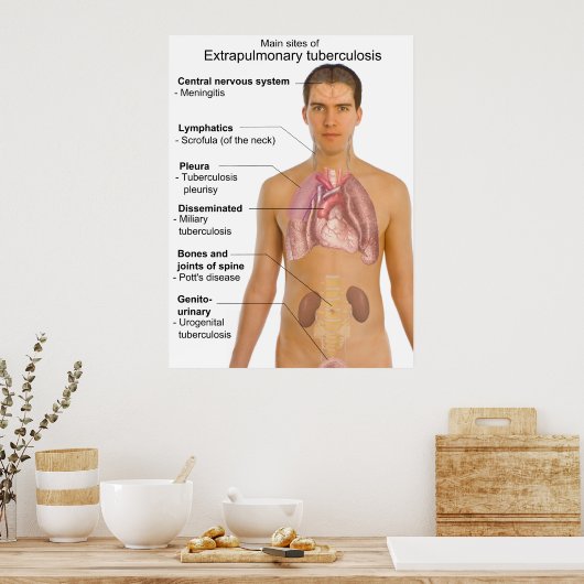 Belangrijkste symptomen van extrapulmonale tubercu poster (Keuken)