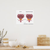 Benigne prostaathyperplasie, gelabeld schema. poster (Keuken)