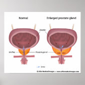 Benigne prostaathyperplasie, gelabeld schema. poster (Voorkant)