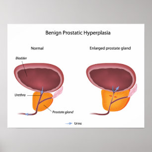 Benigne prostaathyperplasie Poster