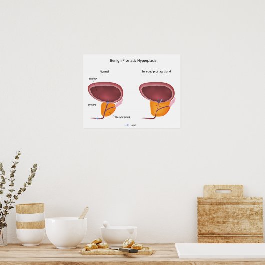 Benigne prostaathyperplasie Poster (Keuken)