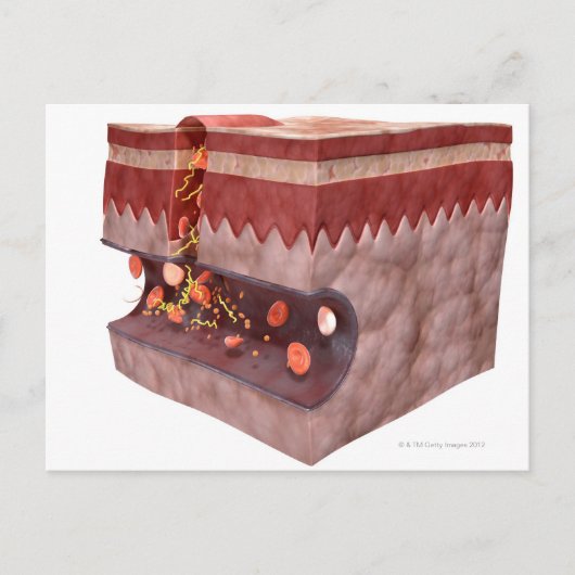 Bloedklokvorming Briefkaart (Voorkant)