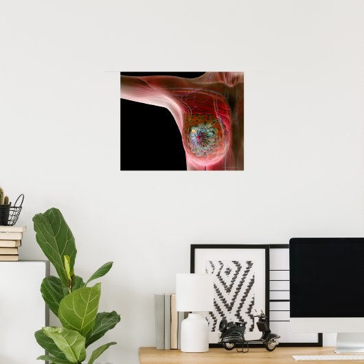 Borstkanker 2 poster (Thuiskantoor)