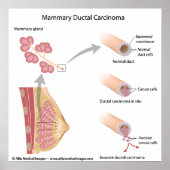 Borstkanker ductaal carcinoom, met een schema. poster (Voorkant)