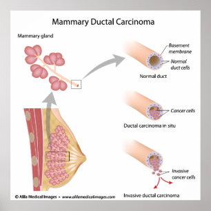 Borstkanker ductaal carcinoom, met een schema. poster