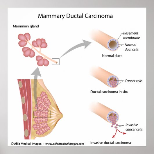 Borstkanker ductaal carcinoom, met een schema. poster (Voorkant)
