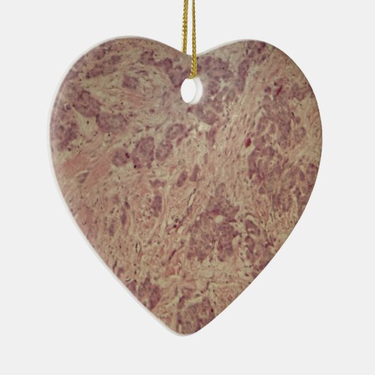 Borstkanker onder de microscoop keramisch ornament (Rechts)