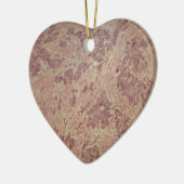 Borstkanker onder de microscoop keramisch ornament (Links)