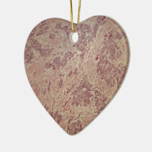 Borstkanker onder de microscoop keramisch ornament (Links)