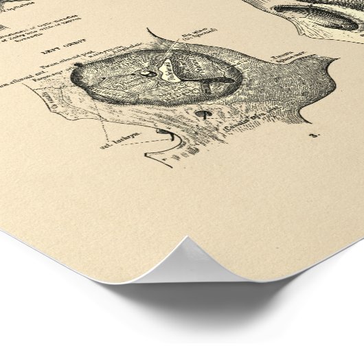  Botten van de Huid 1880 Afdrukken Poster (Hoek)