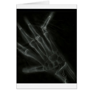 Breuken hand-röntgenfoto