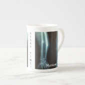 Breuken Radius en Ulna Xray "Pauze tijd" Porselein Kop (Voorkant rechts)
