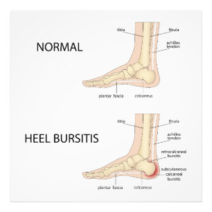 Bursitis calcanealis foto afdruk