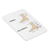 Bursitis calcanealis magneet (Rechterzijde)