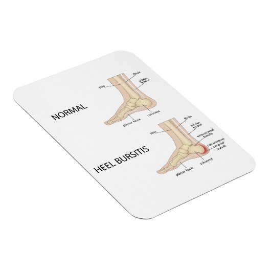 Bursitis calcanealis magneet (Rechterzijde)
