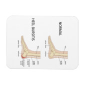 Bursitis calcanealis magneet (Horizontaal)