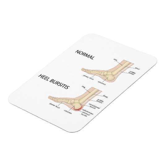 Bursitis calcanealis magneet (Linkerzijde)