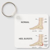 Bursitis calcanealis sleutelhanger (Voorkant)