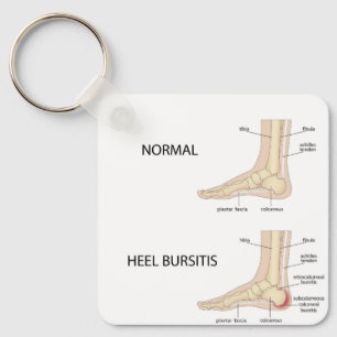 Bursitis calcanealis sleutelhanger