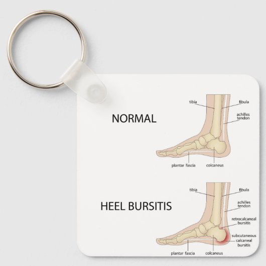 Bursitis calcanealis sleutelhanger (Voorkant)