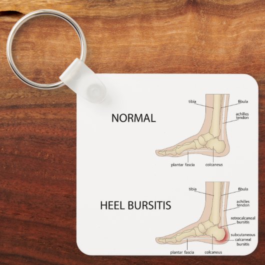 Bursitis calcanealis sleutelhanger (Voorkant)
