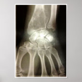 Carpals Xray Poster (Voorkant)