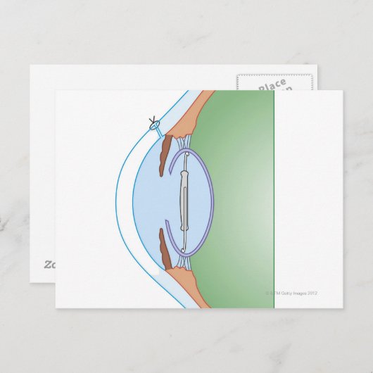 Cataractoperatie Briefkaart (Voorkant / Achterkant)