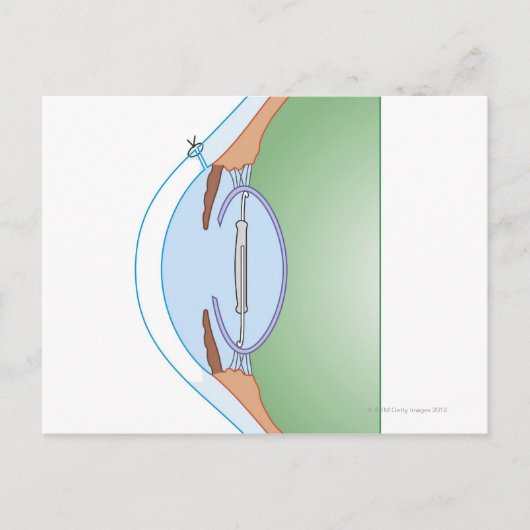 Cataractoperatie Briefkaart (Voorkant)