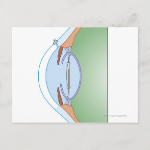 Cataractoperatie Briefkaart