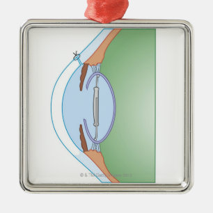 Cataractoperatie Metalen Ornament