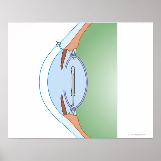 Cataractoperatie Poster (Voorkant)