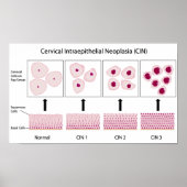 cervicale dysplasiestadia en pap-smear-test poster (Voorkant)