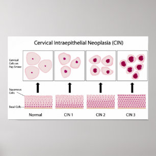 cervicale dysplasiestadia en pap-smear-test poster