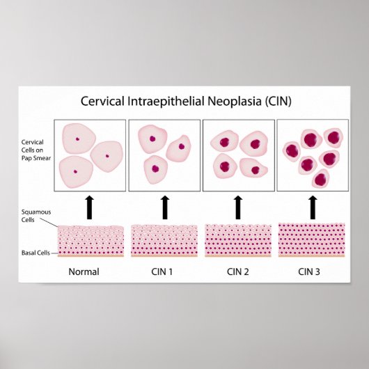 cervicale dysplasiestadia en pap-smear-test poster (Voorkant)