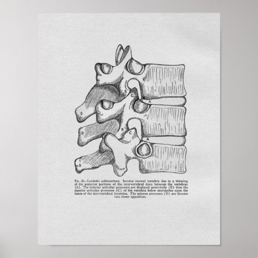 Chiropractic Subluxation Vintage Print (Voorkant)