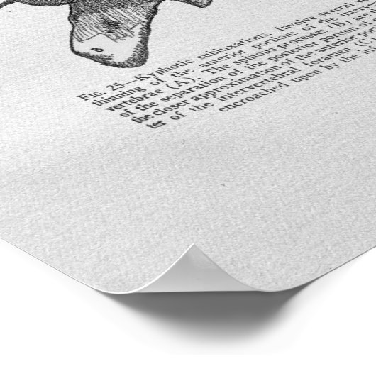 Chiropractische subluxe afdruk poster (Hoek)