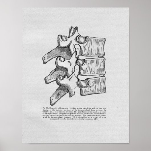 Chiropractische subluxe  afdruk poster (Voorkant)