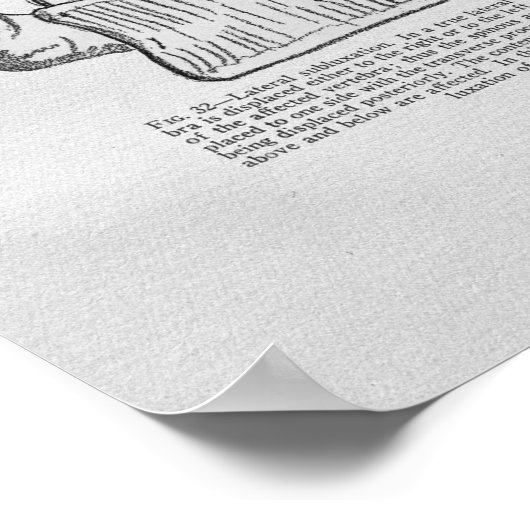 Chiropraktijkvertebrale subluxe  afdruk poster (Hoek)