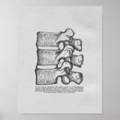 Chiropraktijkvertebrale subluxe  afdruk poster (Voorkant)