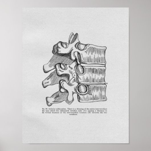 Chiropraktijkvertebrale subluxe afdruk poster (Voorkant)
